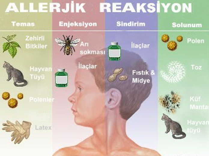 Alerjik Rinit Nedir