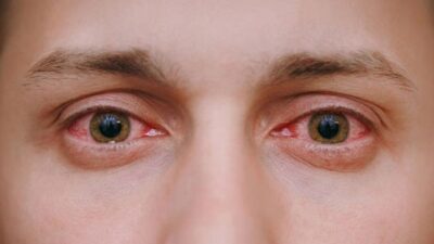Konjonktivit (Kırmızı göz hastalığı) Nedir?