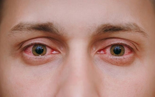 Konjonktivit (Kırmızı göz hastalığı) Nedir?