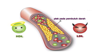 HDL Kolestrol Düşüklüğü Nedir ve Nasıl Düzelir?