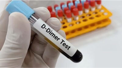 D Dimer Testi Nedir? D Dimer Yüksekliği Nedir?