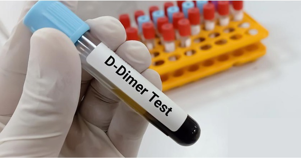 D Dimer Testi Nedir? D Dimer Yüksekliği Nedir?